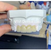 Quality Zirconia Crowns PFZ Zirconia Porcelain Crown Dental Tooth Crown for sale