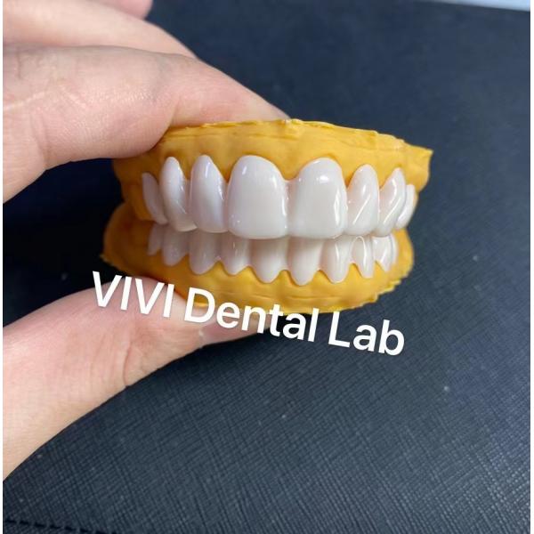 Quality Dental Snap On Smile Veneers High esthetics ISO FDA Certified for sale