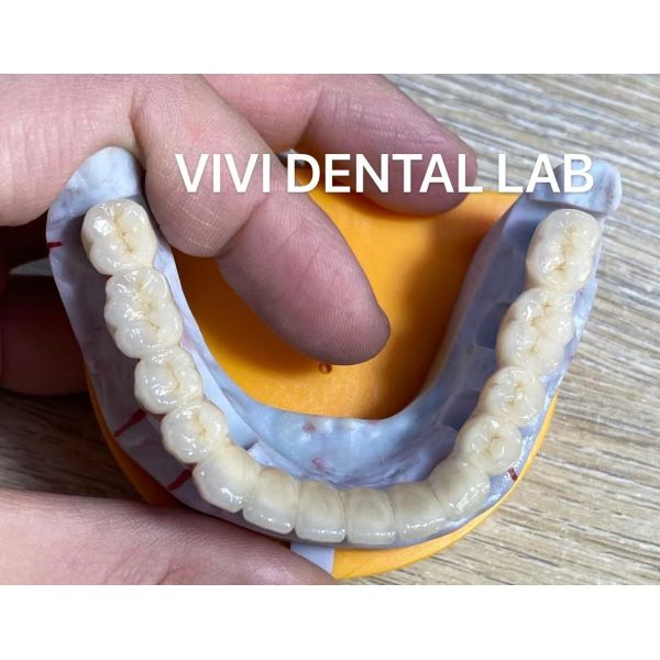 Alloy Dental Implant Supported Crowns Implants And Bridges Digital from China Factory