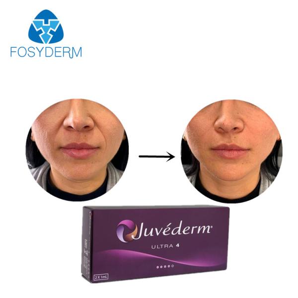 Quality Juvederm Cross Linked Hyaluronic Acid Dermal Filler Allergan Ultra 4 for sale