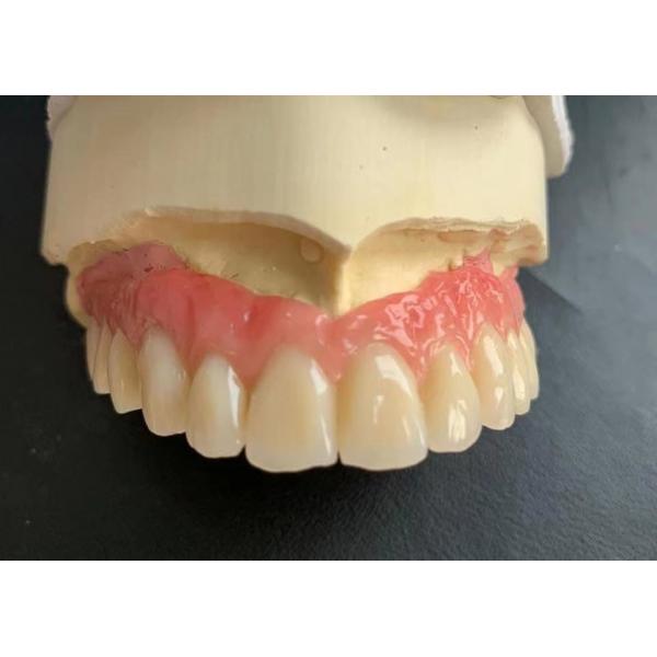 Quality Telescopic Crown Implant Supported Dentures Ivoclar Scheftner On Titanium Abutments for sale