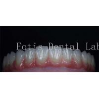China Smooth Surface Cosmetic Tooth Coverings Natural Porcelain Veneers Customizable factory