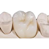 China White Porcelain Zirconia Dental Crown High Density Unobstructed factory