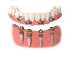Quality VIVI Sheftner Ivoclar Implant Supported Dentures With Locators for sale