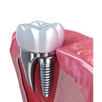China The Strength Behind Our Success Our Dental Implant Crown Technicians factory