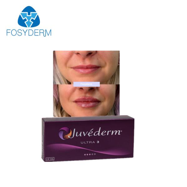 Quality Juvederm Ultra3 Dermal Lip Fillers Cross Linked Lip Enhancement Hyaluronic Acid for sale