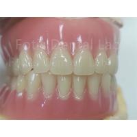 China Comfort Custom Fit Full Acrylic Denture For Precise Dental Prosthesis factory