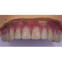 China Patient Comfort Custom Dental Crowns Polished Titanium/Zirconia/PFM Implant Crown factory