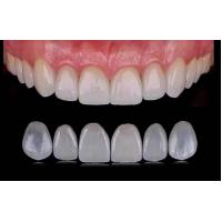 China Tranlucent Emax Laminate Veneers / Porcelain Dental Veneers ISO Approved factory