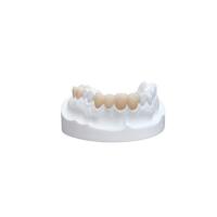 Quality Inlays Onlays Ceramic Dental Crown Strong Veneer For Dental Department for sale