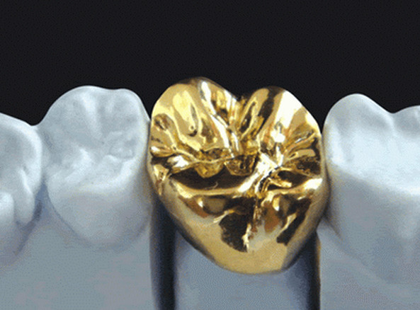 Quality High Nobel Yellow Gold Crown Professional Ni Be Free ISO Approved for sale