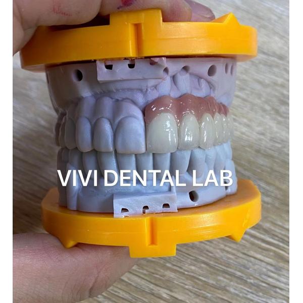 Quality Ivoclar PFM Digital Dental Crowns Bridge Symmetrical With Pink Porcelain for sale