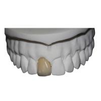 Quality Co Cr Porcelain Dental Crown for sale