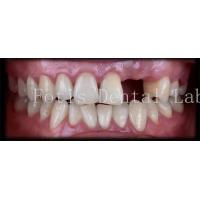 China Customised Natural Temporary Dental Veneers For A Beautiful Smile factory