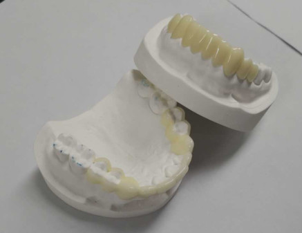 Quality Custom TEMP Porcelain Tooth Crown Inlay Onlay Strong Hardness Veneer for sale