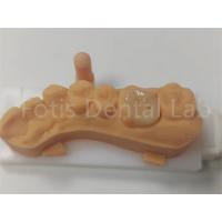 China Dental Restorations Ceramic Inlay And Onlay For Long Lasting factory
