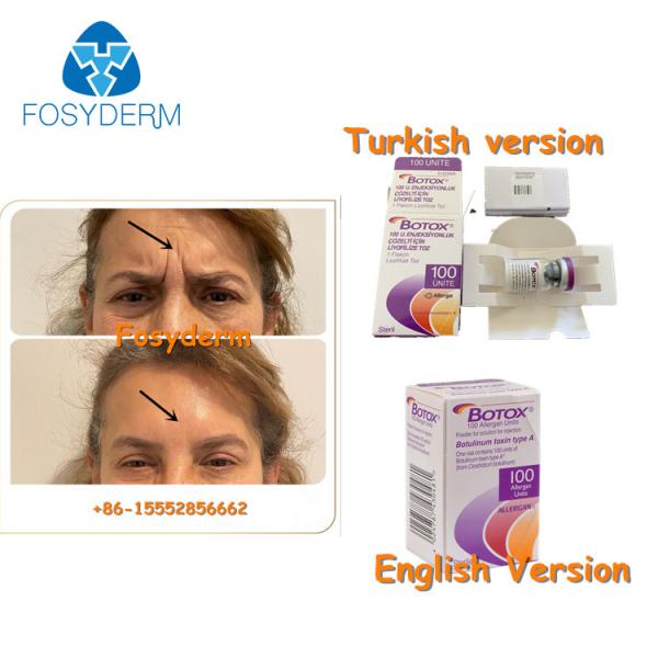 Quality 100Units Allergan Botulinum Toxion For Remove Facial Wrinkles Botox Type A for sale