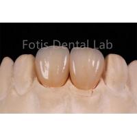 China High Translucency Multi Layer Zirconia For Fabrication Of Dental Restorations factory