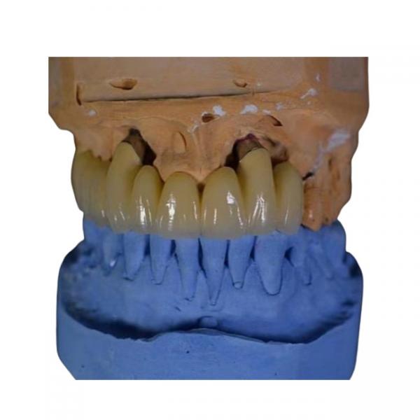 Quality FDA PFM Crown Porcelain fused to Metal Crown for sale