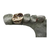 Quality Full Metal PFM Dental Crown Bridge High Tech Biological Material for sale