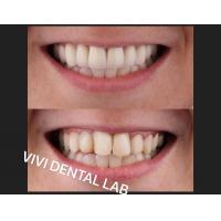 Quality NI Be Free Dental Crowns In Mouth Professional FDA Certified for sale