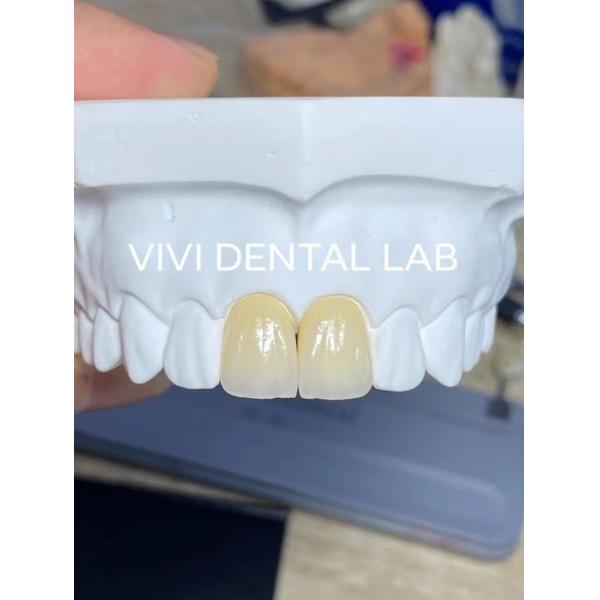 Quality Accurate Dental Lab Crowns Ivoclar Esthetic Zirconia Crowns Natural Looking for sale