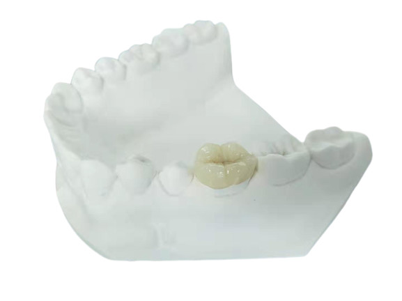 Quality Durable FDA All-Ceramic Dental Crown Veneer Inlay Onlay Similar for sale