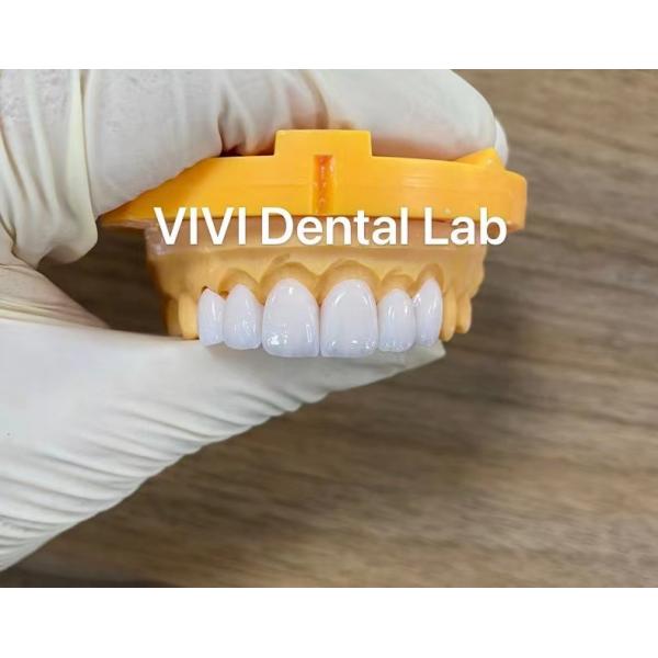 Quality Ivoclar Emax Laminate Veneers High Translucency China Dental Lab for sale