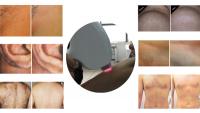 China 800 nm - 810 nm Medical Chin Diode Laser Hair Removal Machine For Clinic / Hospital factory