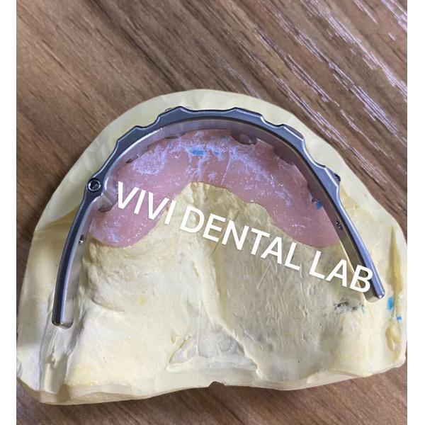Quality Dental Implant Bar Supported Dentures Precise For Edentulous for sale