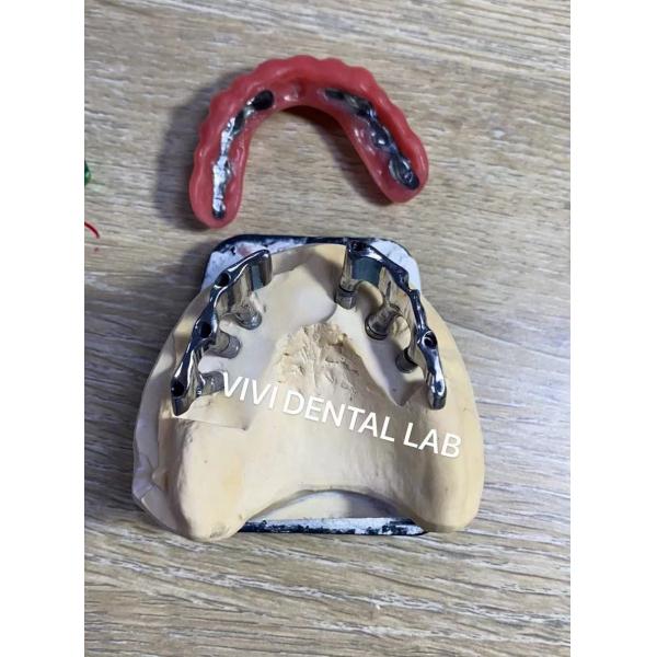 Quality Dental Implant Bar Supported Dentures Precise For Edentulous for sale