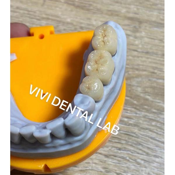 Quality High Accuracy Digital Dental Crowns Model Printed Noritake Porcelain for sale