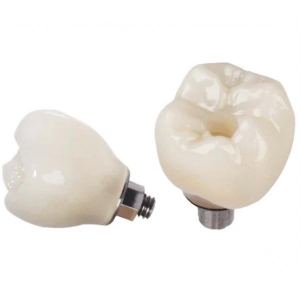 Quality Screw Retained Dental Implant Crown PFZ Porcelain Layered Zirconia for sale