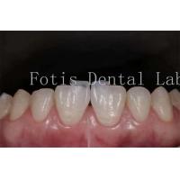 China Polishing Synthetic Dental Laminate Veneers High Stain Resistance factory