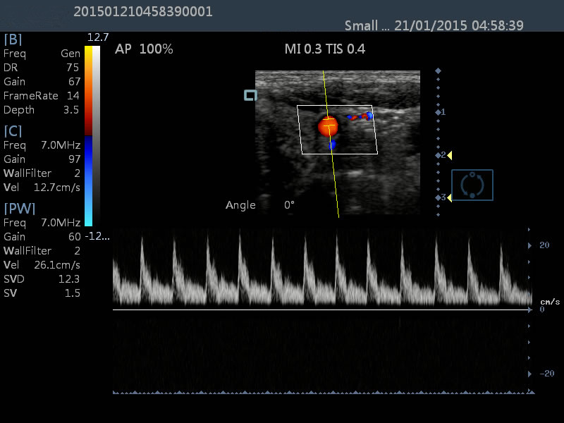 15 Inch Touch LCD 2D Ultrasound Color Dopple Machine Portable Diagnostic Ultrasound Device