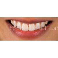 China High End Cosmetic Teeth Veneers For Perfect Smile Stain Resistance factory