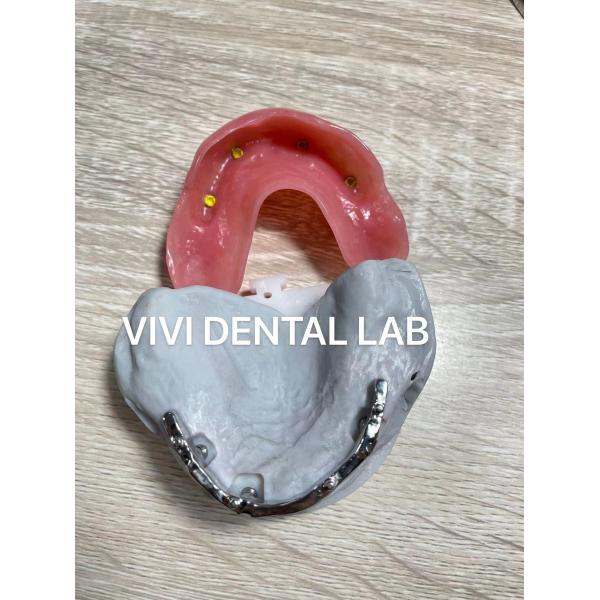 Quality Ivoclar Digital Dental Implant Bar Denture With Attachments for sale