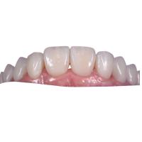 Quality 0.3MM Whitening Ceramic Dental Crown To Replace Unhealthy Teeth for sale