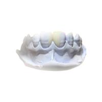 Quality PFM Dental Crown for sale