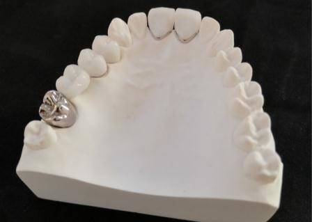 Quality Customized PFM Porcelain Dental Crown Full Metal Corrosion Resistance for sale