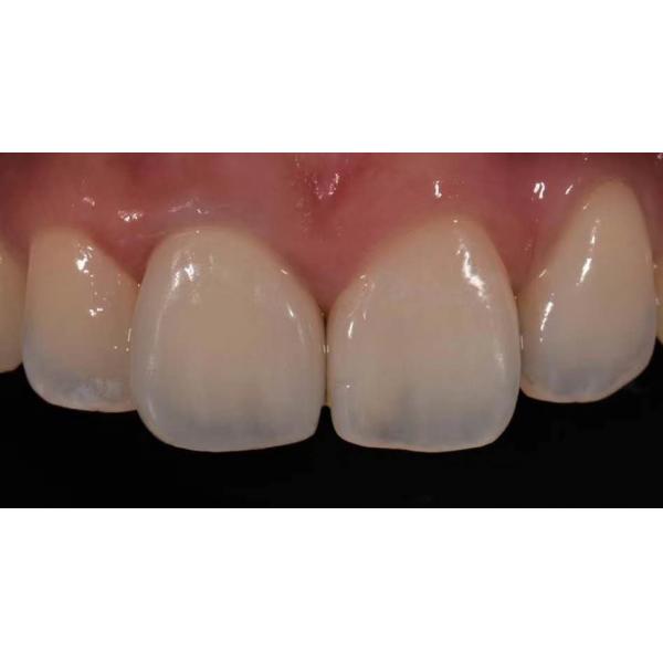 Quality High Biocompatibility PFM Crown Porcelain Fused For Back Teeth Restoration for sale