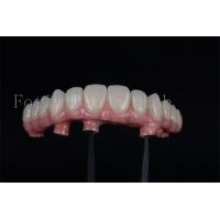 China Natural looking Full Chewing Ability Restoration with 4 Or 6 Implants factory