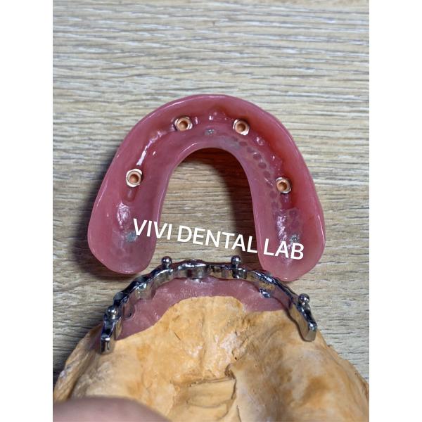 Quality Dental Bar Implant Assisted Dentures High Esthetics Good Fit with attachments for sale