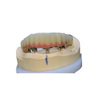 Quality Easy Cleaning Dental Implant Crown Comfortable No Foreign Body Sensation for sale