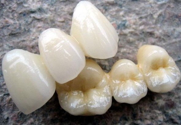 Quality High Biocompatibility PFM Crown Porcelain Fused For Back Teeth Restoration for sale