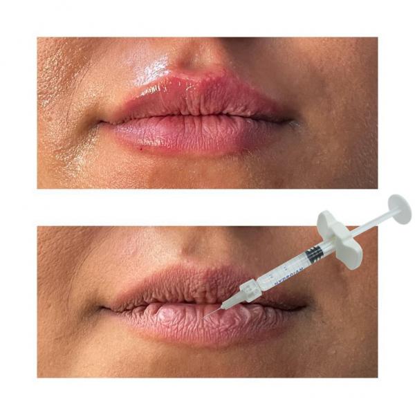 Quality Injectable Hyaluronic Acid Dermal Filler Lip Enhancement Fillers for sale