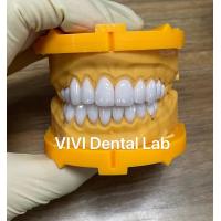 china Ivoclar Emax Laminate Veneers High Translucency China Dental Lab