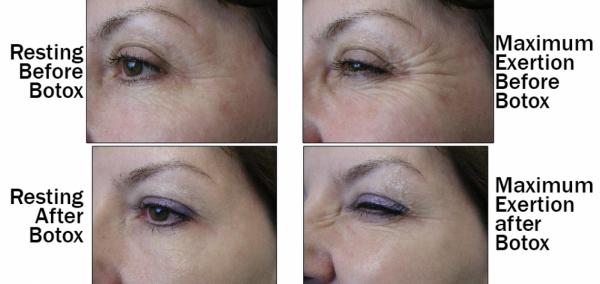 Botox for Wrinkles | Baylor Medicine