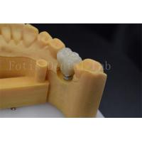 China Easy To Place And Adjust Implant Retained Crown Polished Surface Treatment factory