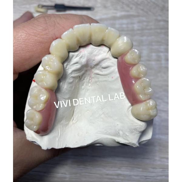 Quality Ni Be Free Dental Lab Crowns Telescopic Secondary Primary Teeth Crowns for sale